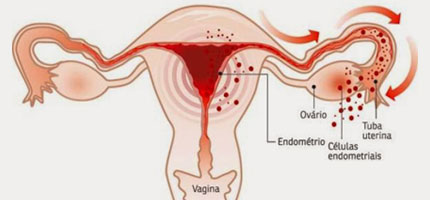 endometriose-ilustra